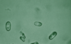 <p>Name this pathogenic dumbbell form of a typically normal acidic crystal, and what the pathogenic form indicates:</p>