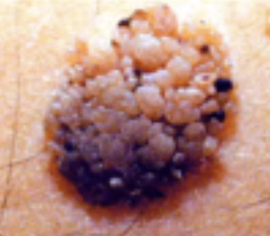 <p>Common Skin Variation</p><ul><li><p>Common in elderly patient</p></li><li><p>Warty &amp; crusty pigmented skin/lesion</p></li><li><p>Can be removed by minor surgery</p></li></ul><p></p>