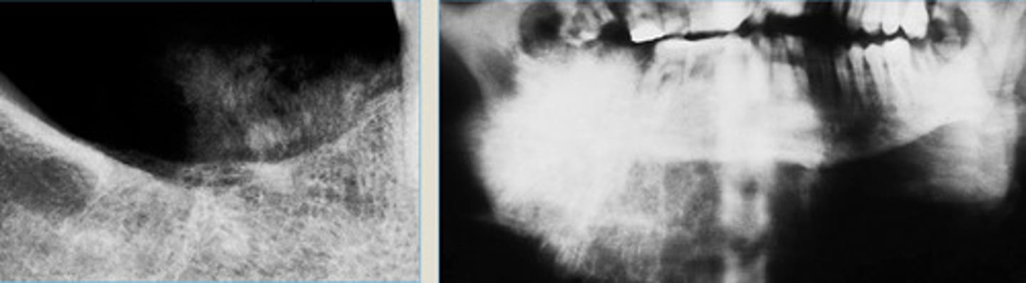 <p>Osteosarcoma of MN showing sunburst pattern of tumor radiating from alveolar ridge (on left) + mandible (on right)</p>