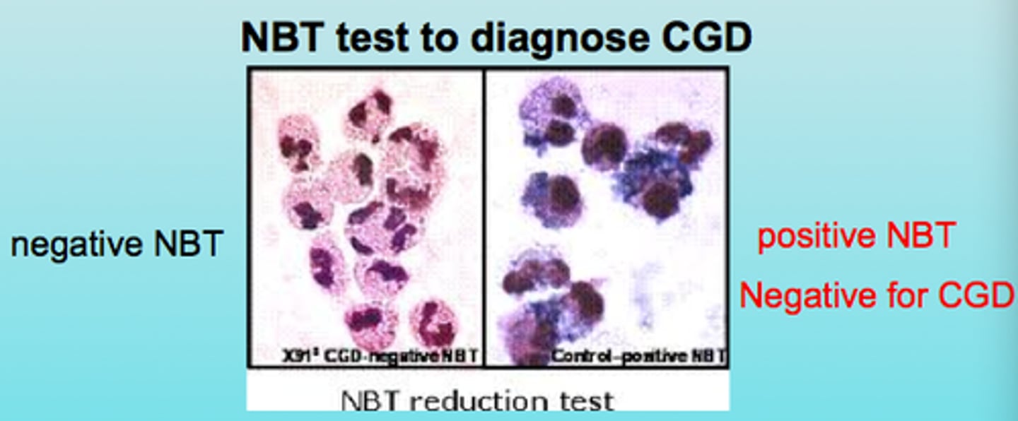 <p>X-linked mutation affecting NADPH oxidase causing dysfunctioning neutrophils and oxidative burst<br>-IgG increased<br>-tested through Nitroblue tetrazolium test (NBT) and flow cytometry<br>-Cannot kill catalase-positive bacteria leading to large masses</p>