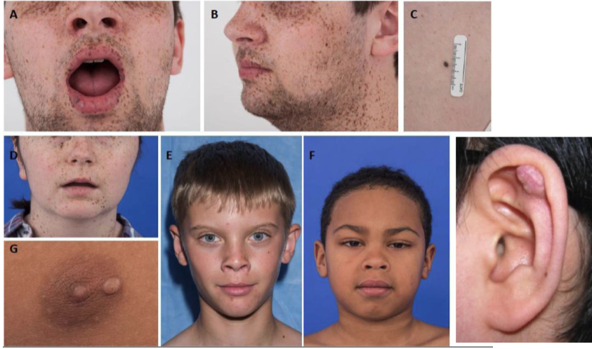 <ol><li><p>cardiac myxomas</p></li><li><p>cutaneous myxomas </p></li><li><p>spotty pigmentation: lentigines on face + lip vermillion border, blue nevi </p></li><li><p>endocrine disease/tumor</p></li></ol><p></p>