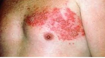 <p><span style="color: red">Herpes Zoster (Shingles) </span></p>