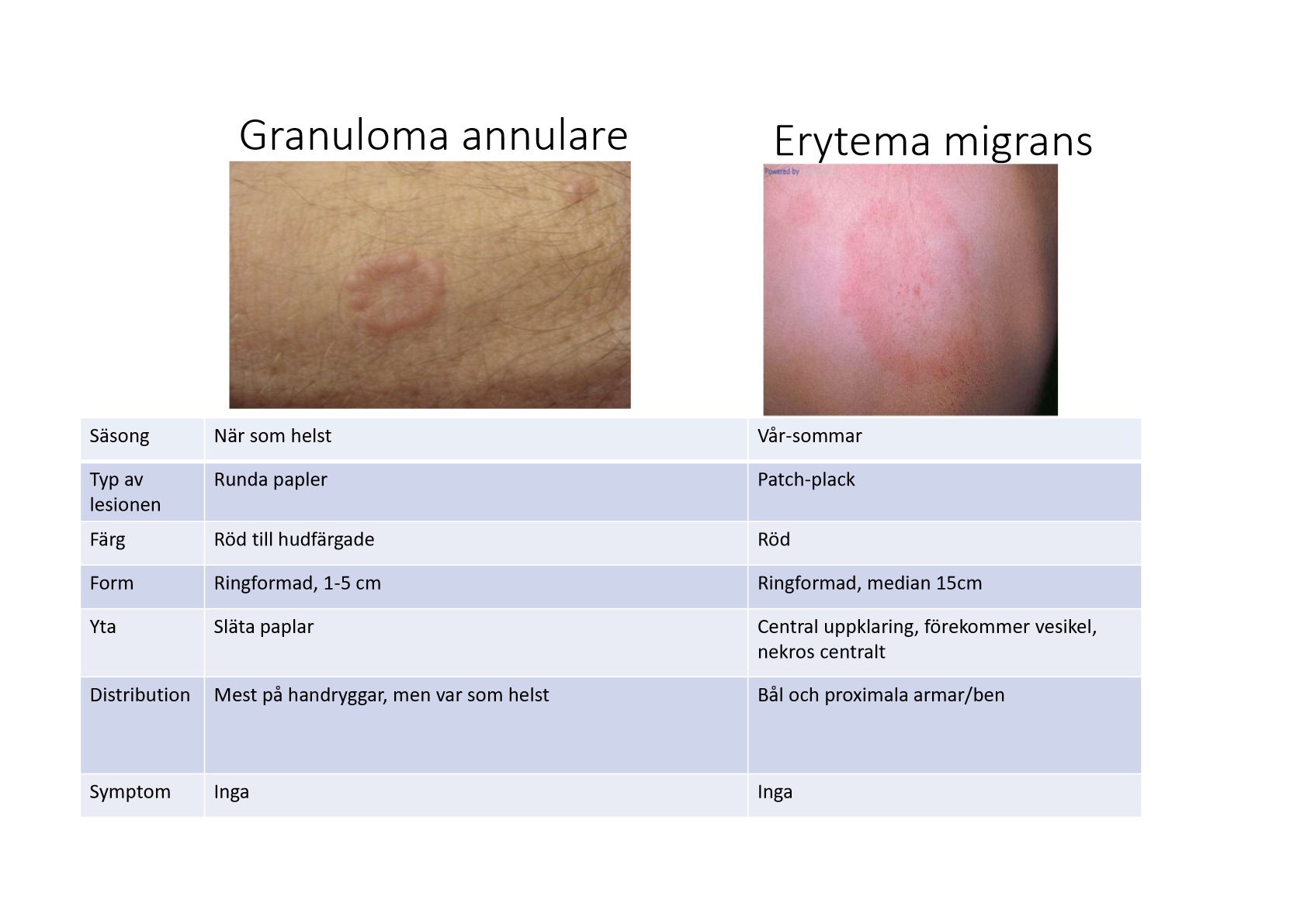 <p>Diffdiagnos till erytema migrans, ser en ringkonformation.</p><ul><li><p>Knölig yta “halsband som bildar ring”</p></li><li><p>Oftast på händerna</p></li><li><p>Inflammatoriskt tillstånd</p></li></ul><p></p>