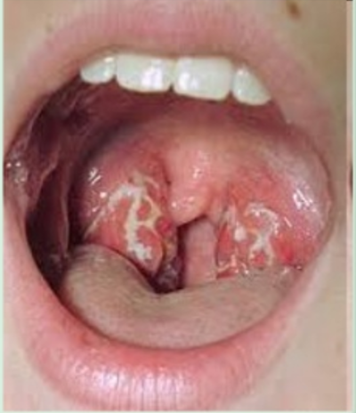 <ul><li><p>Infection of the pharyngeal tonsils</p></li><li><p>Tonsils are swollen, Fever and pain during swallowing usually present</p></li></ul>