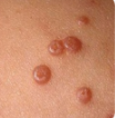 <p>• Raised, round, skin-colored bumps with central umbilication</p><p>• Painless</p><p>-Henderson Paterson bodies on microscopy</p>