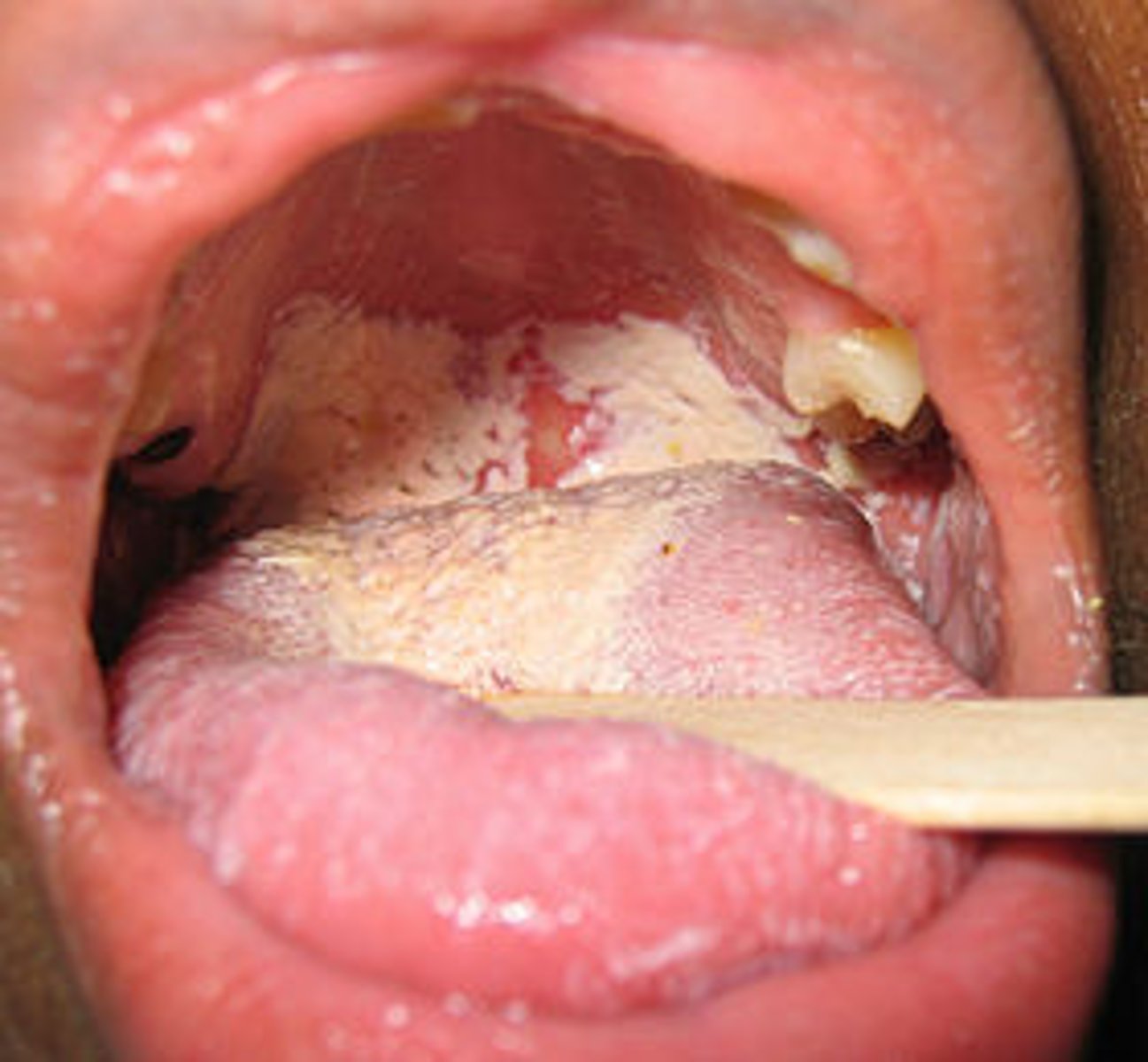 <p>-Most common fungal infection</p><p>-Most common oral lesion in HIV positive pt.</p><p>-Local factors: Xerostomia, complete/partial dentures, steroid inhalers, etc.</p><p>-Systemic factors: Antibiotic therapy, HIV+, uncontrolled diabetes, etc.</p><p>-Several different presentations</p><p>-All can present with burning</p>