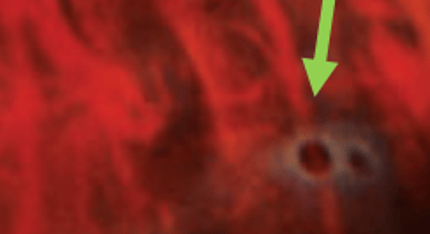 <p>full thickness breaks in the retina caused by retinal thinning thought to be secondary to underlying vascular insufficiency. Is not associated with vitreoretinal traction and patients are usually asymptomatic having low risk for retinal detachment or tears. Common in myopes. Can occur independently or through patches of lattice degeneration.</p>