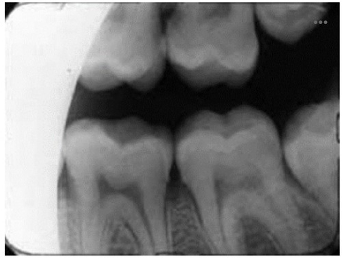 <p>1. Identify the error seen on the dental radiograph above</p><p>2. why did this error occur?</p>