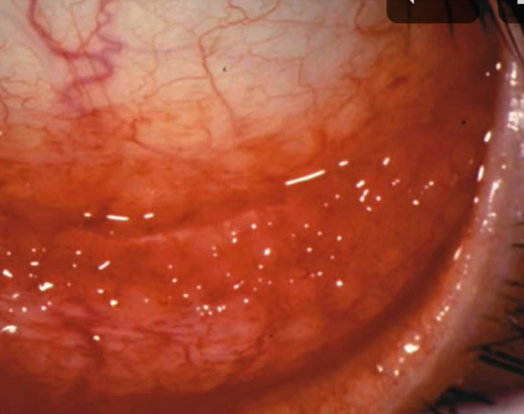 <ol><li><p><strong><u>follicular rxn</u></strong></p></li><li><p>hyperemia </p></li><li><p>lacrimation </p></li><li><p>mild chemosis — swelling of conj</p></li><li><p>no corneal involvement </p></li></ol><p></p>