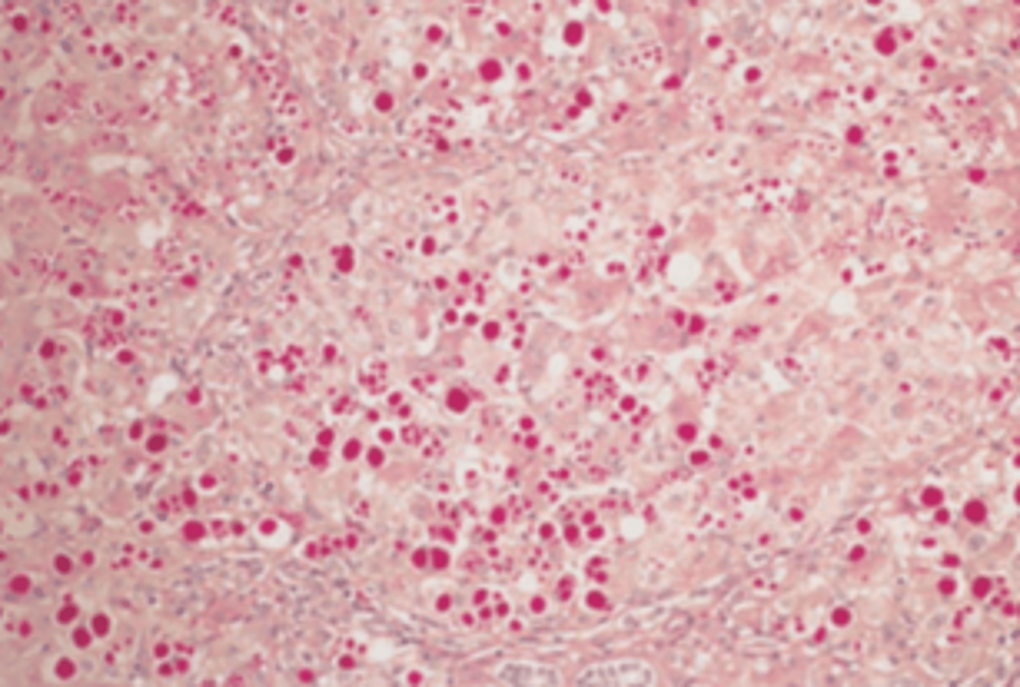 <p>A 32-year-old man presents with a 6-month history of yellow skin and sclerae. Physical examination shows mild jaundice, pitting edema, and ascites. Laboratory studies reveal decreased serum albumin (2.6 g/dL) and increased serum AST and ALT (120 and 140 U/L, respectively). A liver biopsy stained with period acid-Schiff (PAS) reagent and diastase digestion is shown in the image. This patient has which of the following genetic diseases?</p><p>(A) α1-Antitrypsin deﬁciency</p><p>(B) Glycogen storage disease</p><p>(C) Hereditary hemochromatosis</p><p>(D) Hurler syndrome</p><p>(E) Pompe syndrome</p>