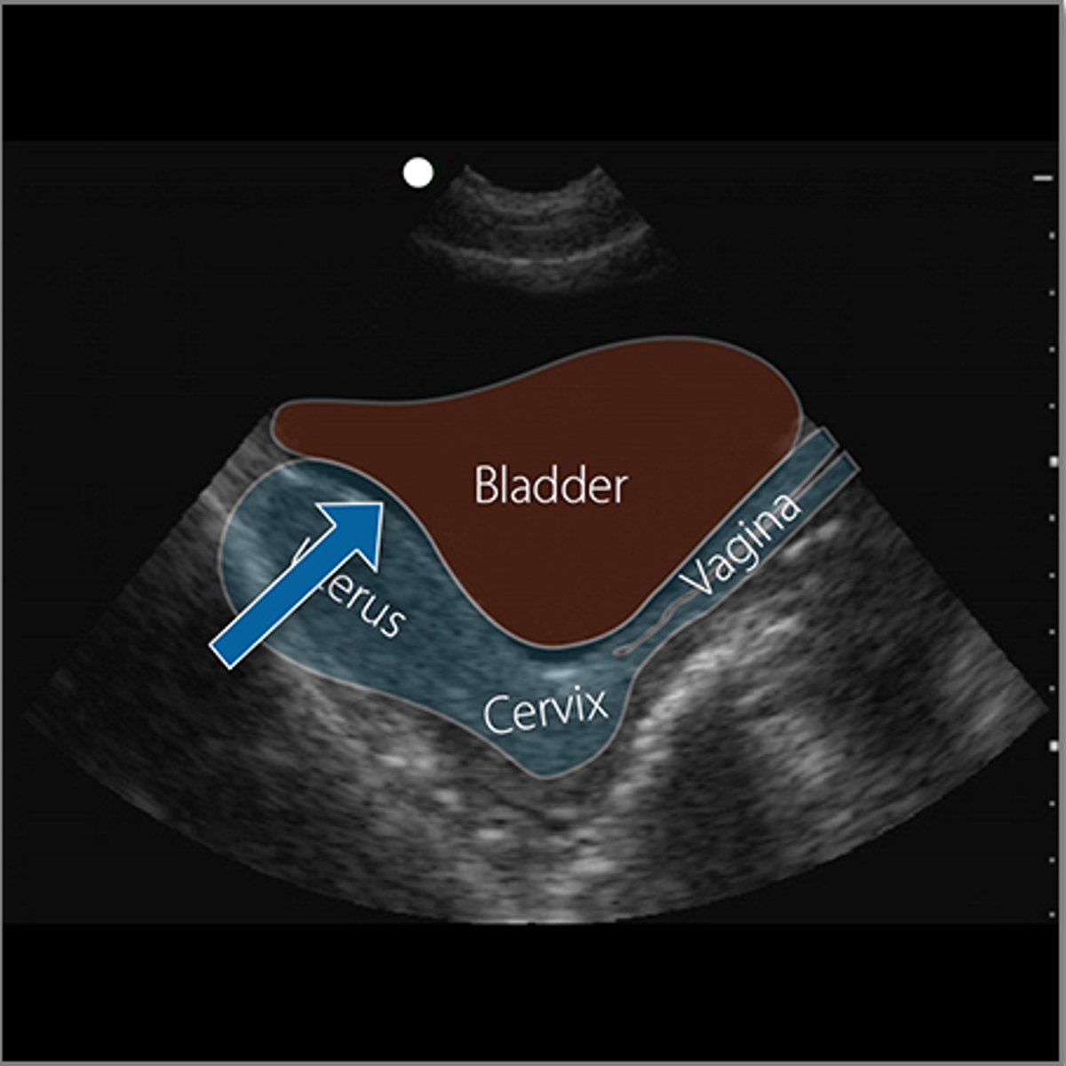 <p>What is the arrow pointing to in this ultrasound image?</p>