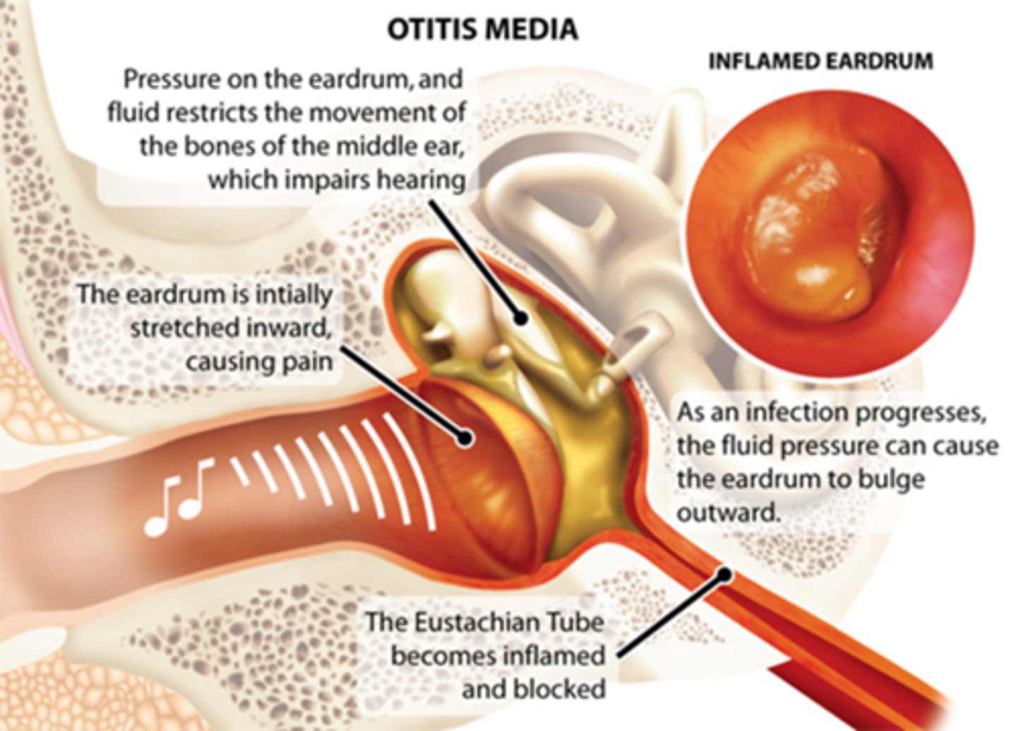 <p>otitis media</p>