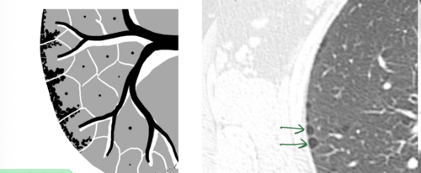 <p>What type of emphysema is this?</p>