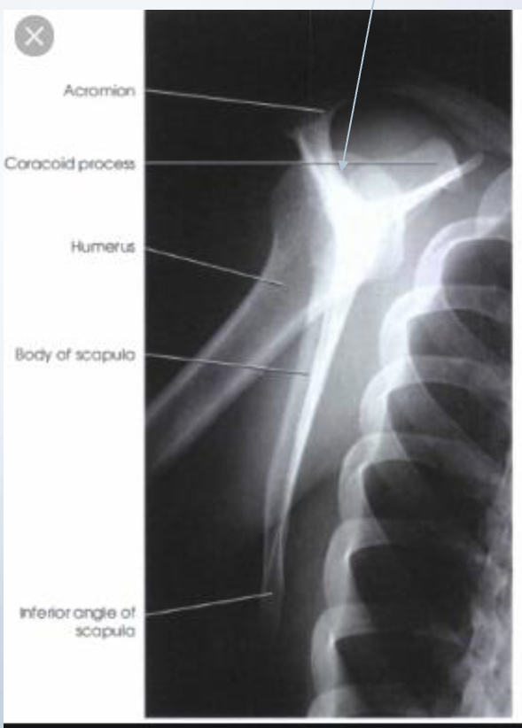 <p>Scapula in lateral position, perpendicular to IR</p><p>Center at vertebral border with patient in anterior oblique</p><p>RAO=LPO 40-60 degree</p><p><span style="color: red;"><span>Borders(lateral and medial) of scapula superimposed</span></span></p><p><span style="color: red;"><span>Free of superimposition by ribs</span></span></p><p><span style="color: red;"><span>Arm elevated</span></span></p><p><span style="color: red;"><span>Humerus not superimposing scapula</span></span></p>