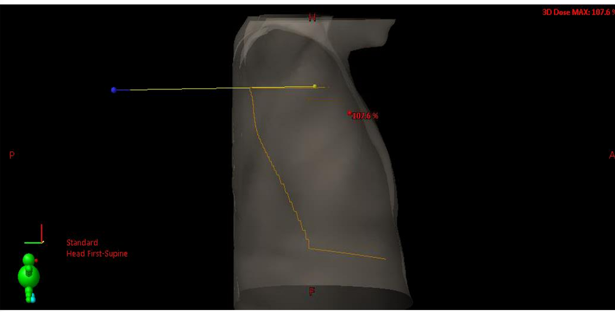 <p>where should the posterior border lie on with the lateral tangent field?</p>