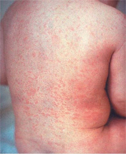 <p>german measles (vaccine)</p><p>pink macular and papular rash</p>