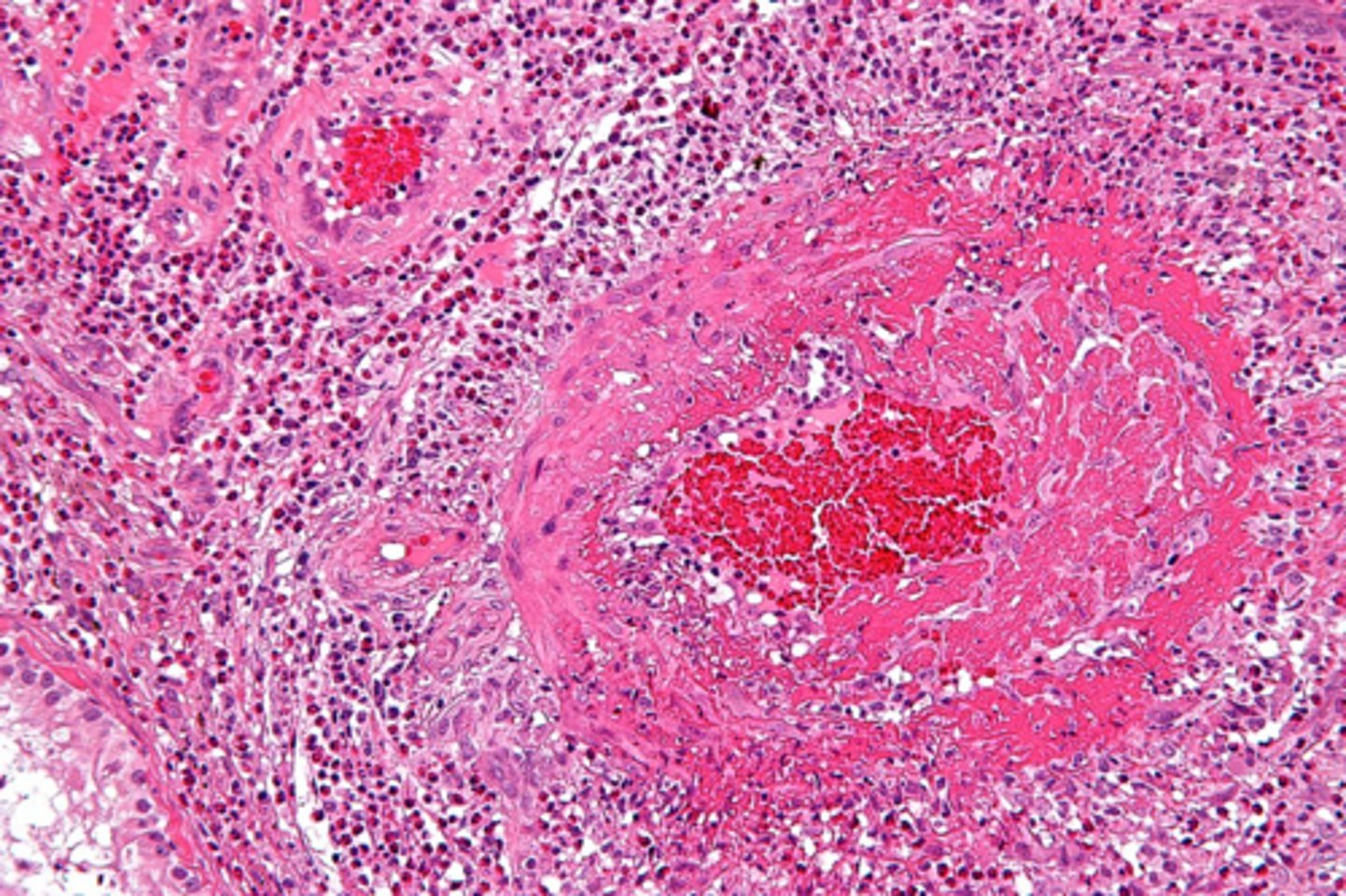 <p>deposits of immune complexes and fibrin, bright pink amorphous appearance ("fibrinoid")</p>