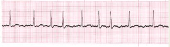 No organized contraction of the atria

Quivering state

Blood clots can develop due to stagnation of blood

Irregular rhythm and pulse