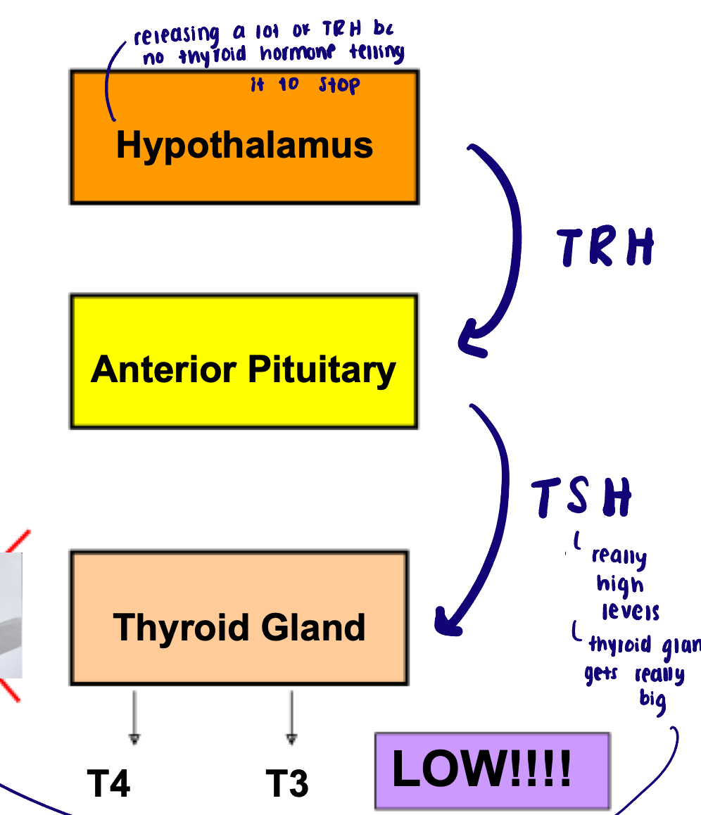 <ul><li><p>Deficient thyroid hormone </p></li><li><p>Most common cause worldwide: iodine deficiency </p></li><li><p>Symptoms: </p><ul><li><p>Tiredness, weakness</p></li><li><p>Dry skin</p></li><li><p>Feeling cold</p></li><li><p>Hair loss</p></li><li><p>Difficulty concentrating</p></li><li><p>Constipation</p></li><li><p>Weight gain with poor appetite </p></li></ul></li><li><p>Goiter: abnormal enlargement of thyroid </p></li></ul><p></p>