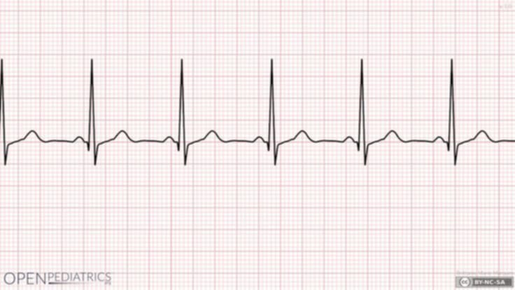 <p>what rhythm is shown in the ECG?</p>