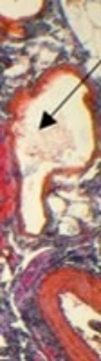 <p>Carries blood TOWARDS the heart</p>