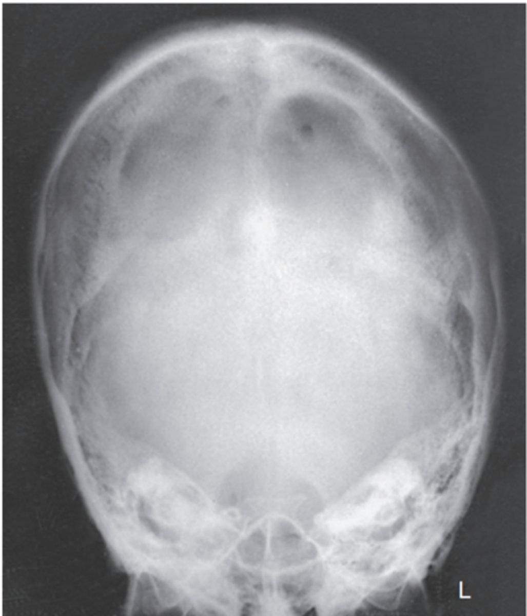 <p>-Position:</p><p>• No rotation is evident, as indicated by bilateral symmetric petrous ridges.</p><p>• Dorsum sellae and posterior clinoid processes are visualized in the foramen magnum, which indicates correct CR angle and proper neck flexion and extension.</p><p>• No tilt as evidenced by correct placement of anterior clinoid processes within the middle of the foramen magnum</p>