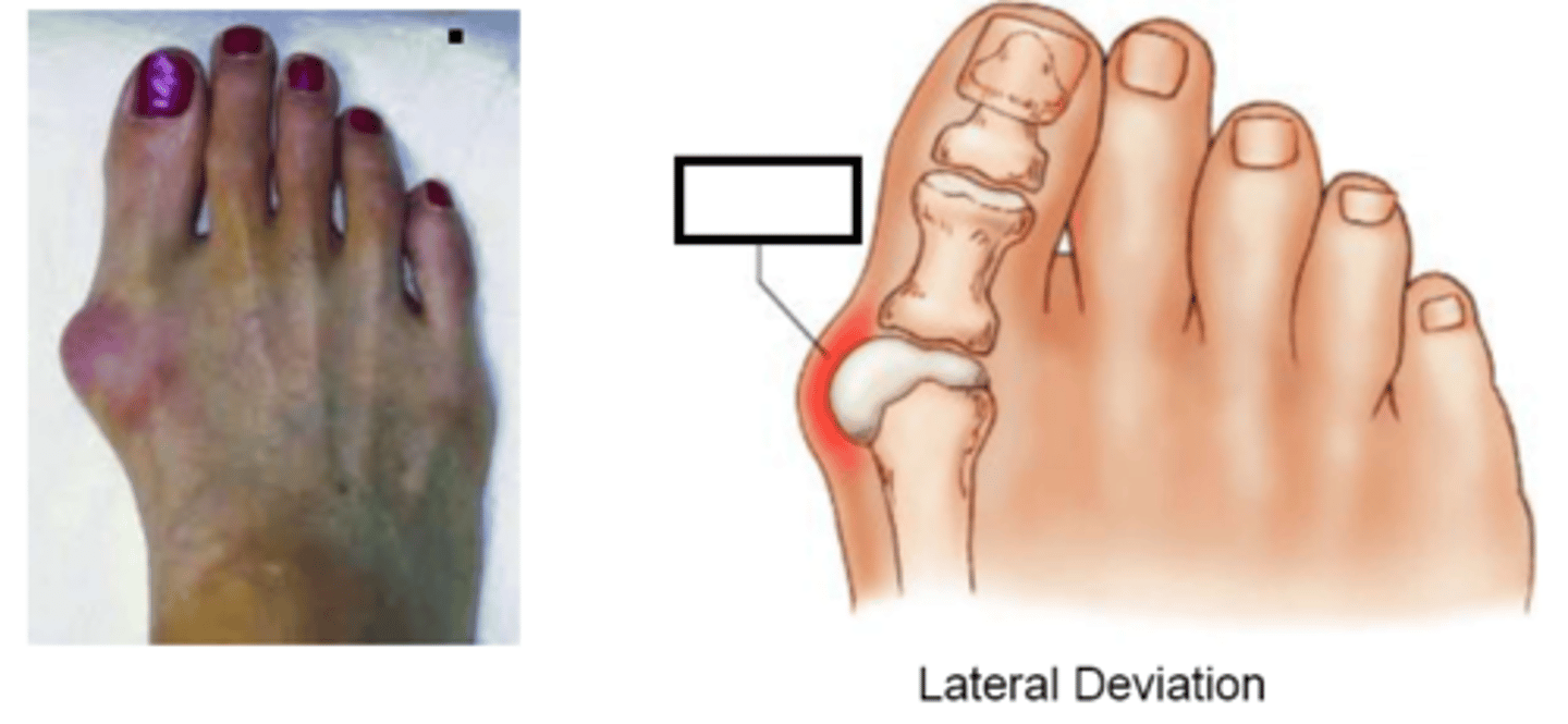 <p>enlargement of bone or tissue around the joint at the base of the big toe</p>