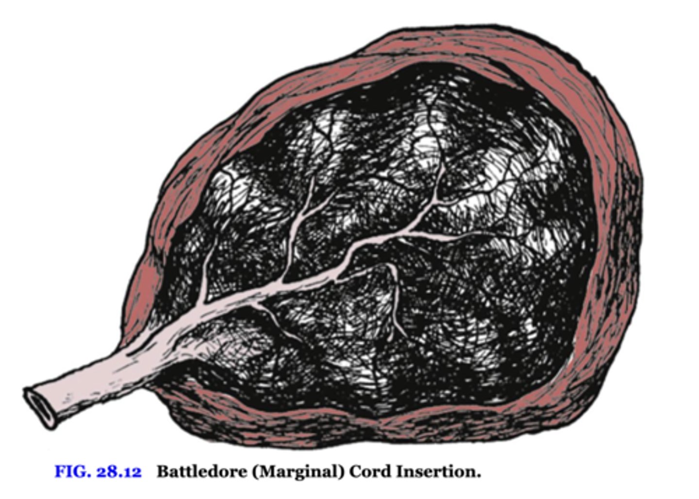 <p>cord inserts at edge of placenta</p>