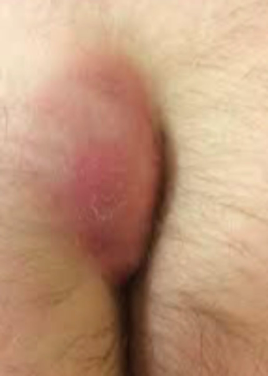 <p>Bacterial ID:</p><p>Overview:</p><p>- Common; occurs at or near upper part of natal cleft (gluteal cleft)</p><p>- Mean age: 19 y/o (women), 21 y/o (men)</p><p>- Men 2-4x more affected than women</p>