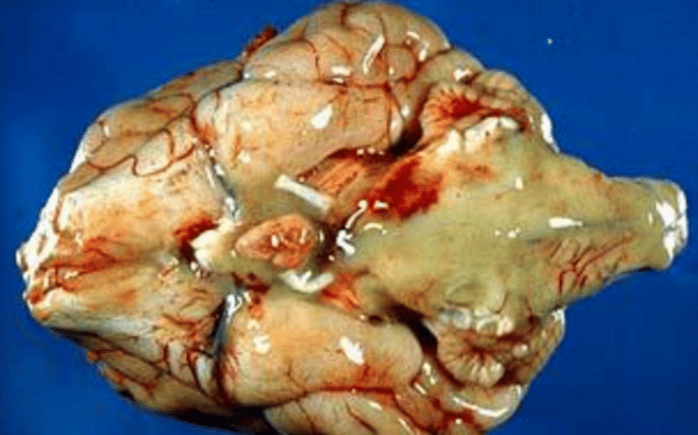 <p>what type of exudate is being depicted in the image?</p>