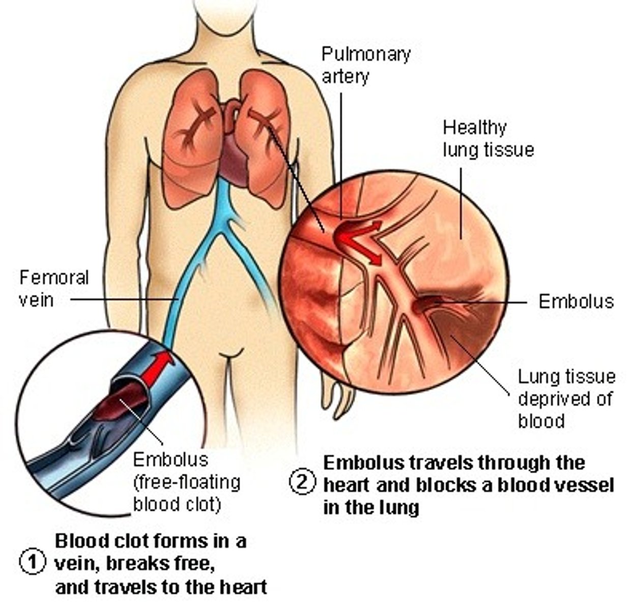 <p>Embolus obstructing a vessel</p><p>---> Example: pulmonary or cerebral emboli</p>
