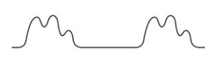 <p>= each pulse has 2 strong systolic peaks with a dip in between</p><p><strong><u>causes: </u></strong></p><ul><li><p>aortic regurgitation</p></li><li><p>aortic stenosis</p></li><li><p>cardiomyopathy</p></li></ul>