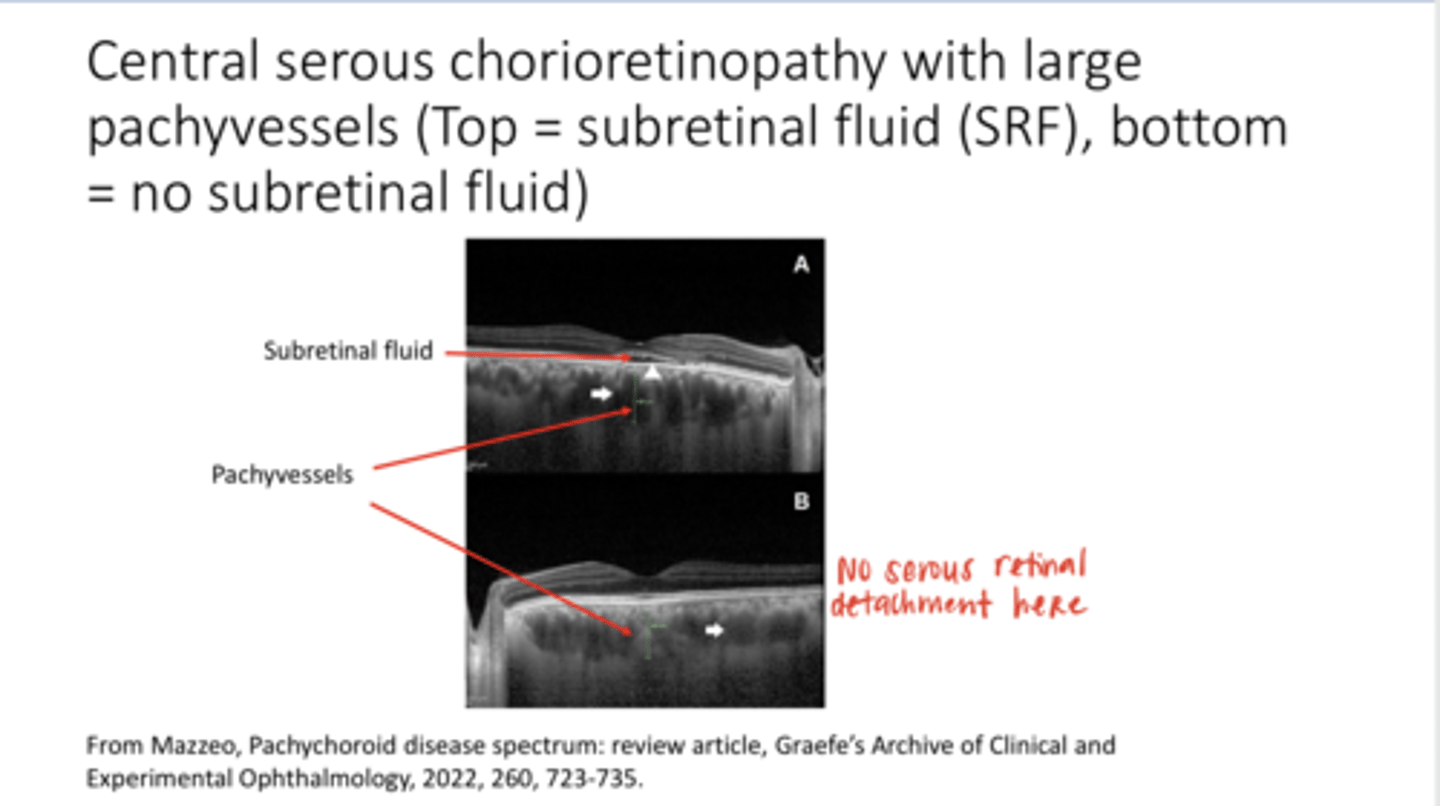 <p>Central serous chorioretinopathy with Large Pachyvessels (Pic)</p>