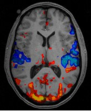 <p><strong>How it works: </strong></p><ul><li><p>Same as MRI but with the deoxygenation of blood. </p></li><li><p>Measuring the oxygen use of the brain region <strong>show cells in that area have become more or less active. </strong></p><ul><li><p><strong>Warm colours</strong> = more activity </p></li><li><p><strong>Cold colours</strong> = reduction in activity </p></li></ul></li><li><p>Used to study how the brain reacts to different stimuli. </p></li></ul><p><strong>Case Studies: Sharot 9/11 and Maguire </strong></p>