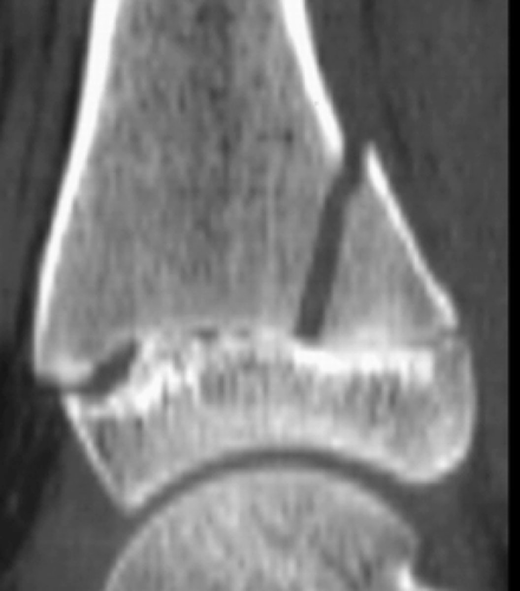 <p>Salter Harris grade?</p>