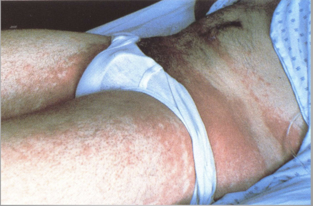 <p>Toxic Shock Syndrome</p>