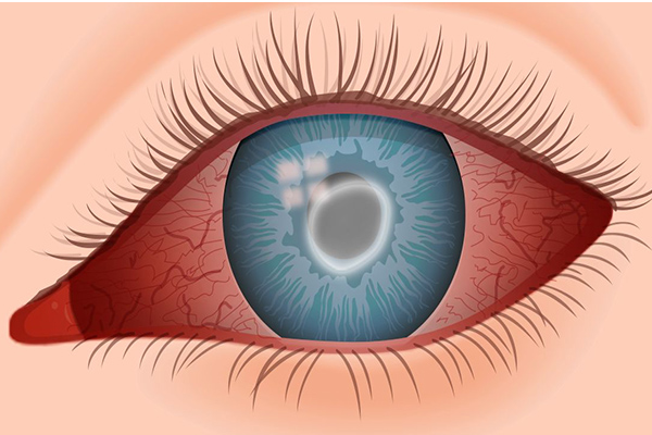 <p>Amebic keratitis</p>