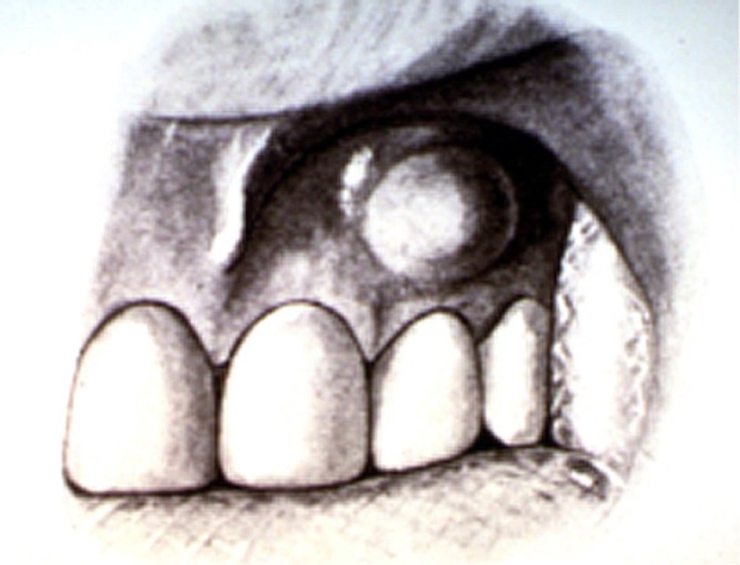 <p>ID the surgical procedure:</p><p>- To allow the release of pus and toxins</p><p>- To alleviate pain</p><p>- Fluctuant swelling</p>