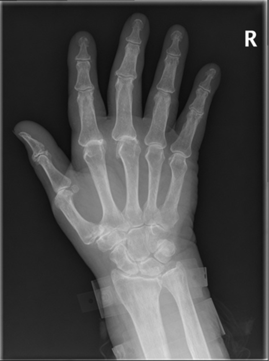 <p>State the clinical features of hemochromatosis</p>