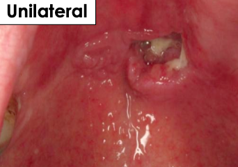<p>Where would find Necrotizing Sialometaplasia?</p>
