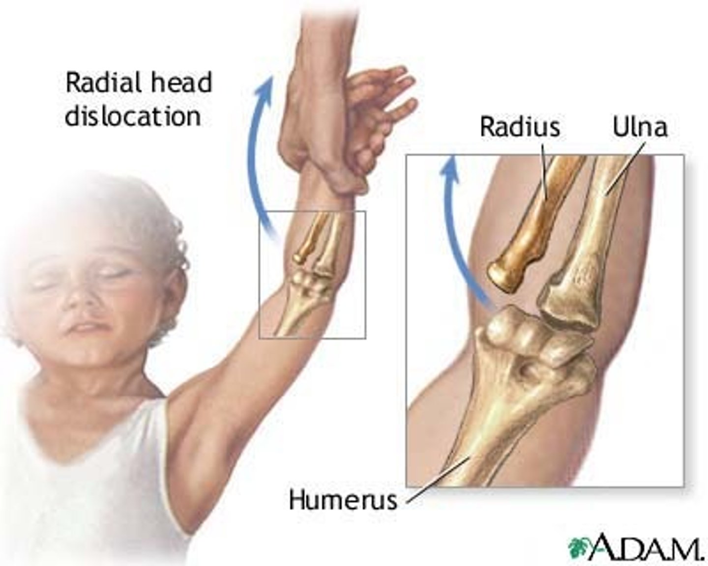 <p>sudden pulling force with twisting (ie. swinging child) that causes immature radial head subluxation OUTSIDE of the annular ligament</p>