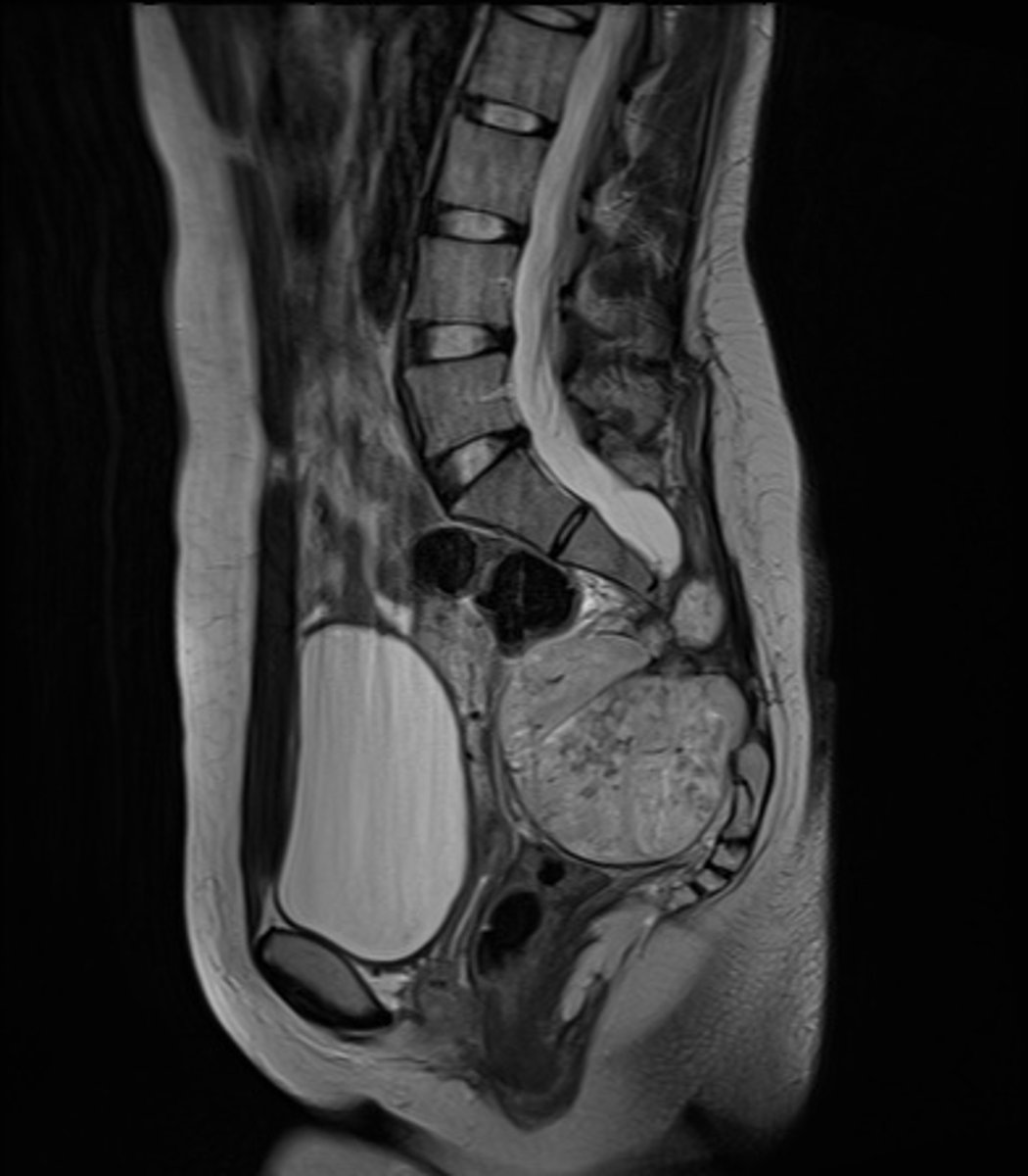 <p>What is the exact lesion of the lesion?</p>