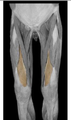 <p>Vastus Medialis </p>