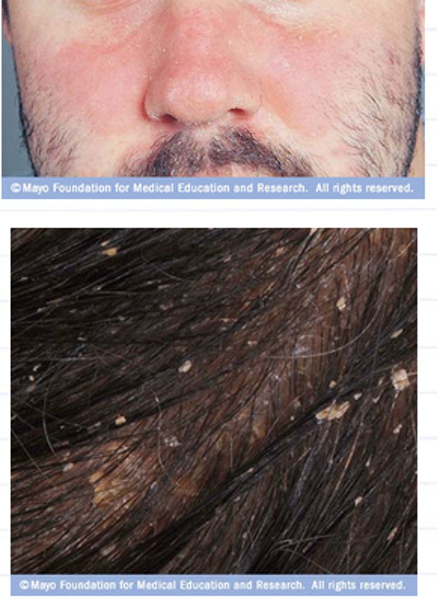 <p>Malassezia furfur (yeast organism) grows on oily skin secretion</p>