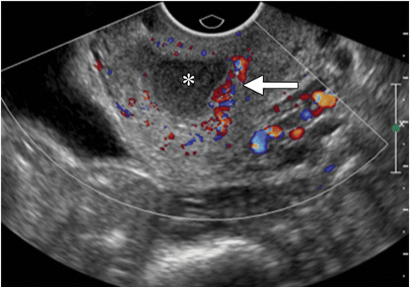 <p>fluid-filled distended endocervical canal (*) with surrounding hyperemia (arrow)</p>