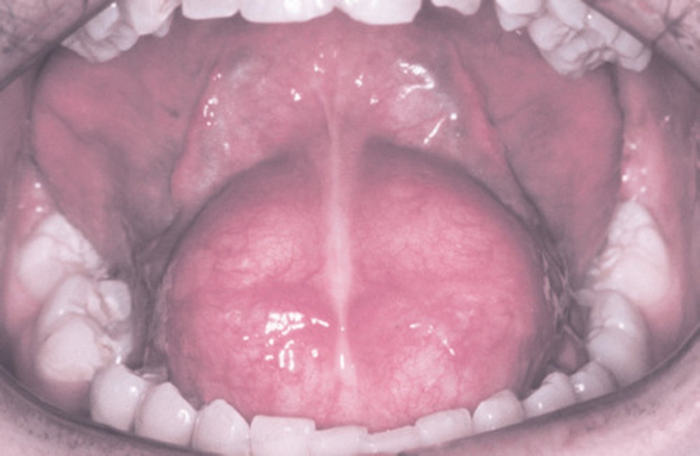 <p> developmental cyst - rare in head and neck</p><p>• lumen of cyst is filled with keratin</p><p>• cyst wall contains hair follicles, sebaceous glands, sweat glands</p><p>• common in ovaries</p>