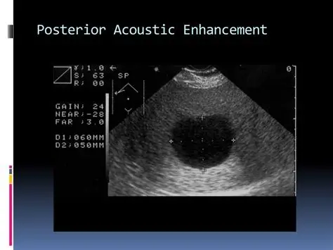 <p>Posterior Enhancement AKA enhancement through transmission</p>