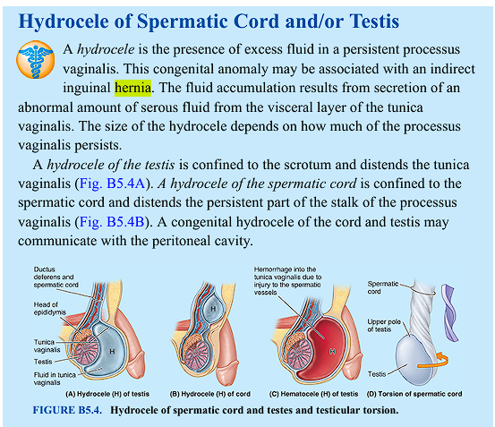 <p>hydrocele is an accumulation of fluid in the testes that can cause an indirect inguinal hernia. </p>