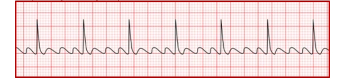<p>Atrial Flutter</p>