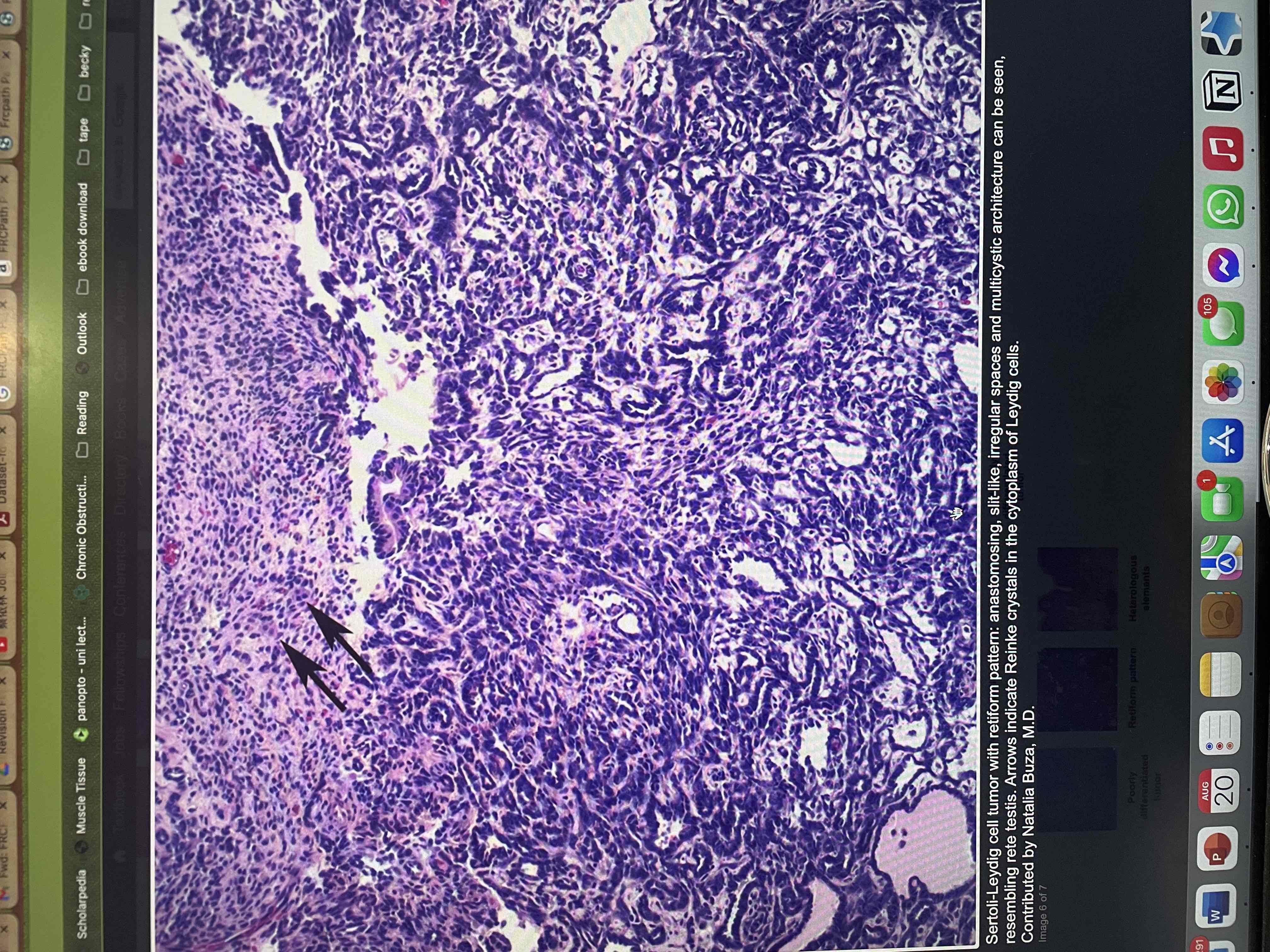 <p>Less diff tumours lack well formed sertoli cell tubules and fewer leydig cells.</p><p></p><p>Well diff - well formed tubules formed by Sertoli cells advised with clusters of leydig cells </p><p></p><p>Intermediate - cords (ie tubules compressed and so without lumen) of sertoli , fewer leydig cells</p><p></p><p>Poor diff - sheets of Sertoli cells ( just looks like spindle cells) and fewer leydig cells </p><p></p><p>Retiform pattern - form slit like spaces looks like rete of testis (pic) </p><p></p><p>With heterologous element eg mucinous epithelium   </p>